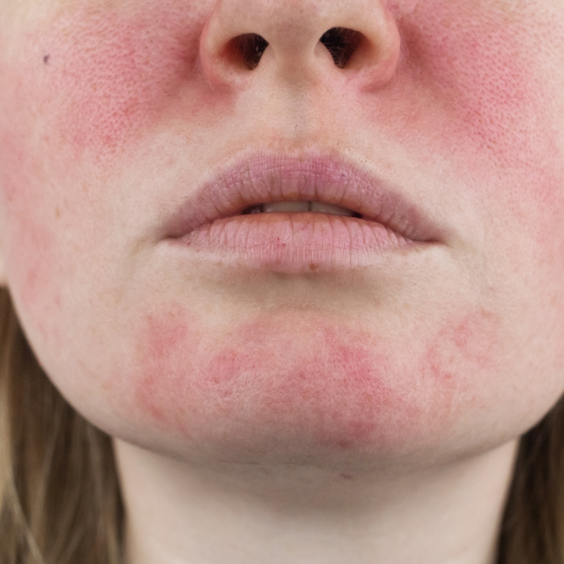 Facial redness and flushing